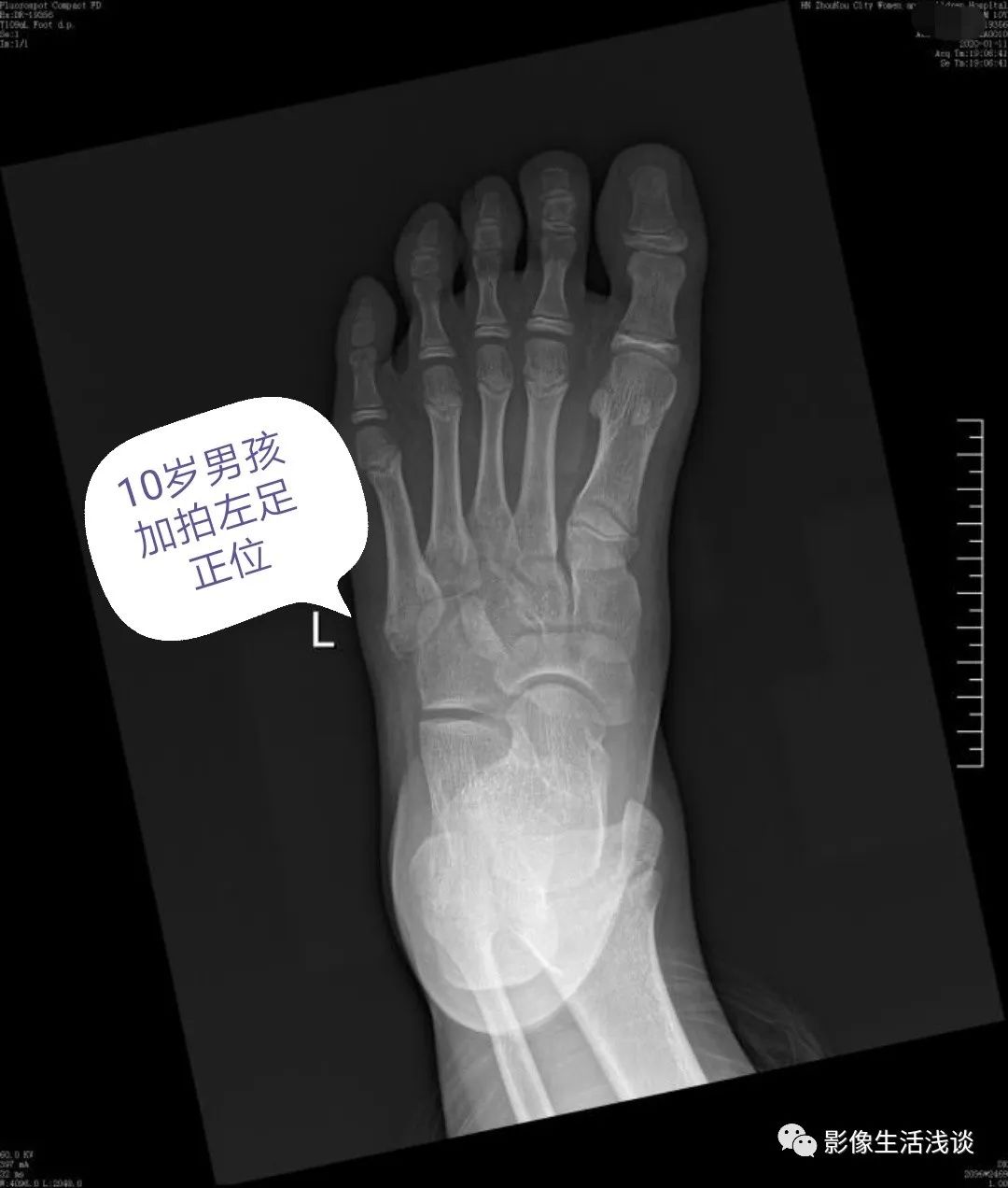 儿童足部x线骨骺图图片